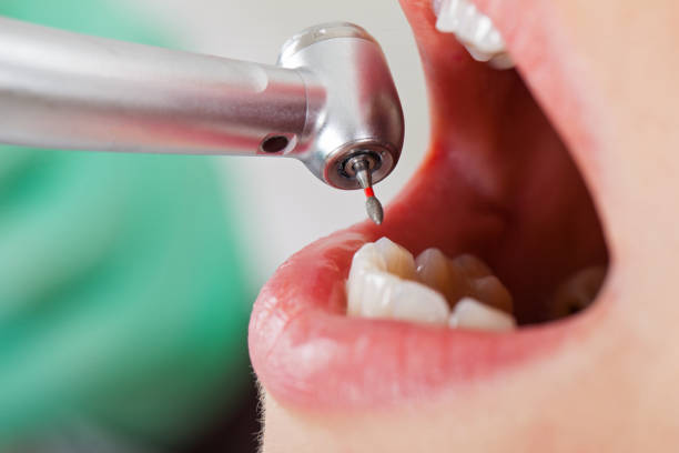 Best Broken or Chipped Tooth Repair in Sand Hill, PA